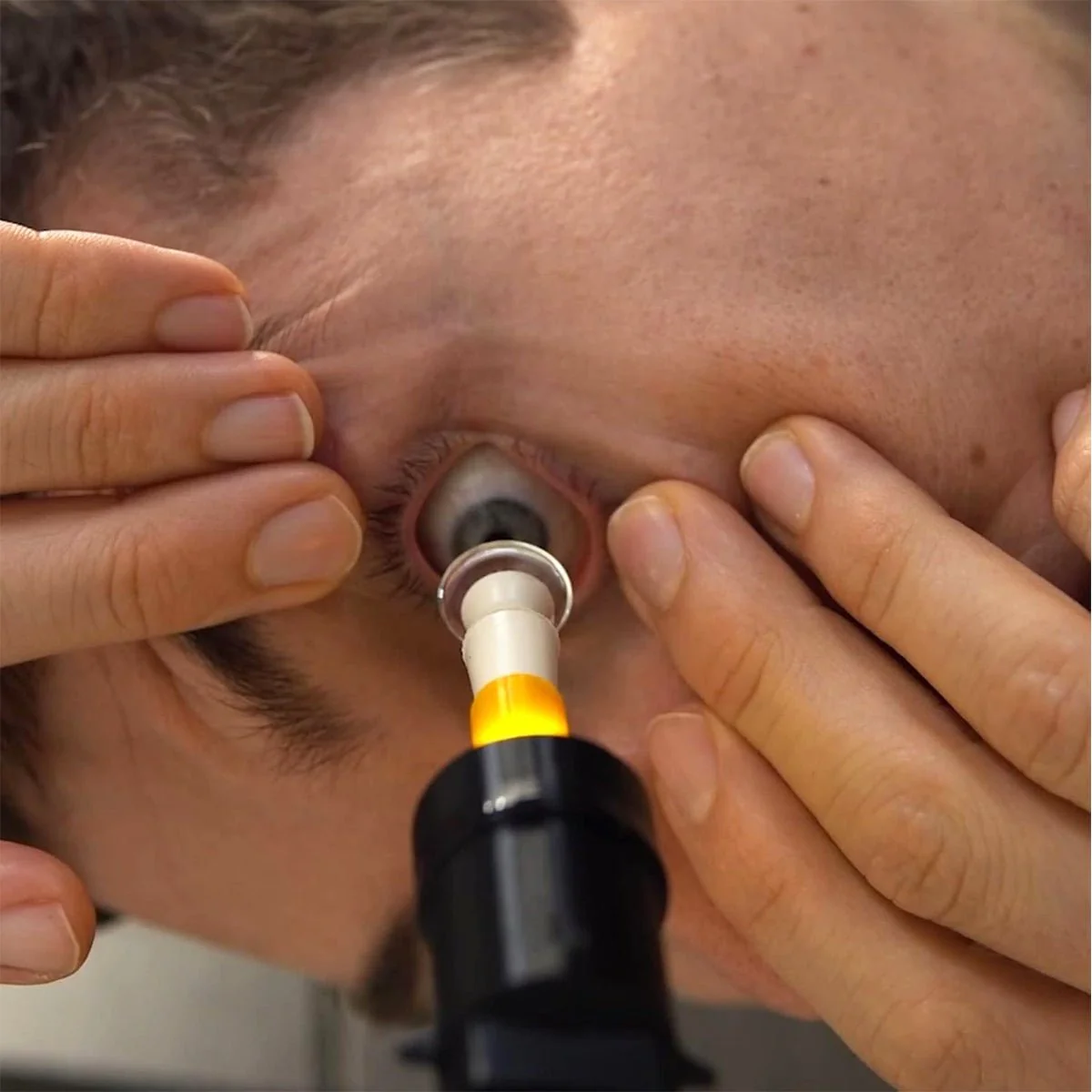 S5 Mini Inserter for Scleral & Hybrid Lens Insertion - With Free Video Training Included - Image 5